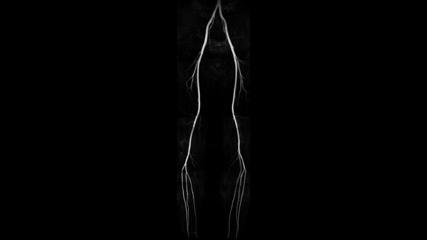 Inhance Deltaflow, acquired in 3 stations