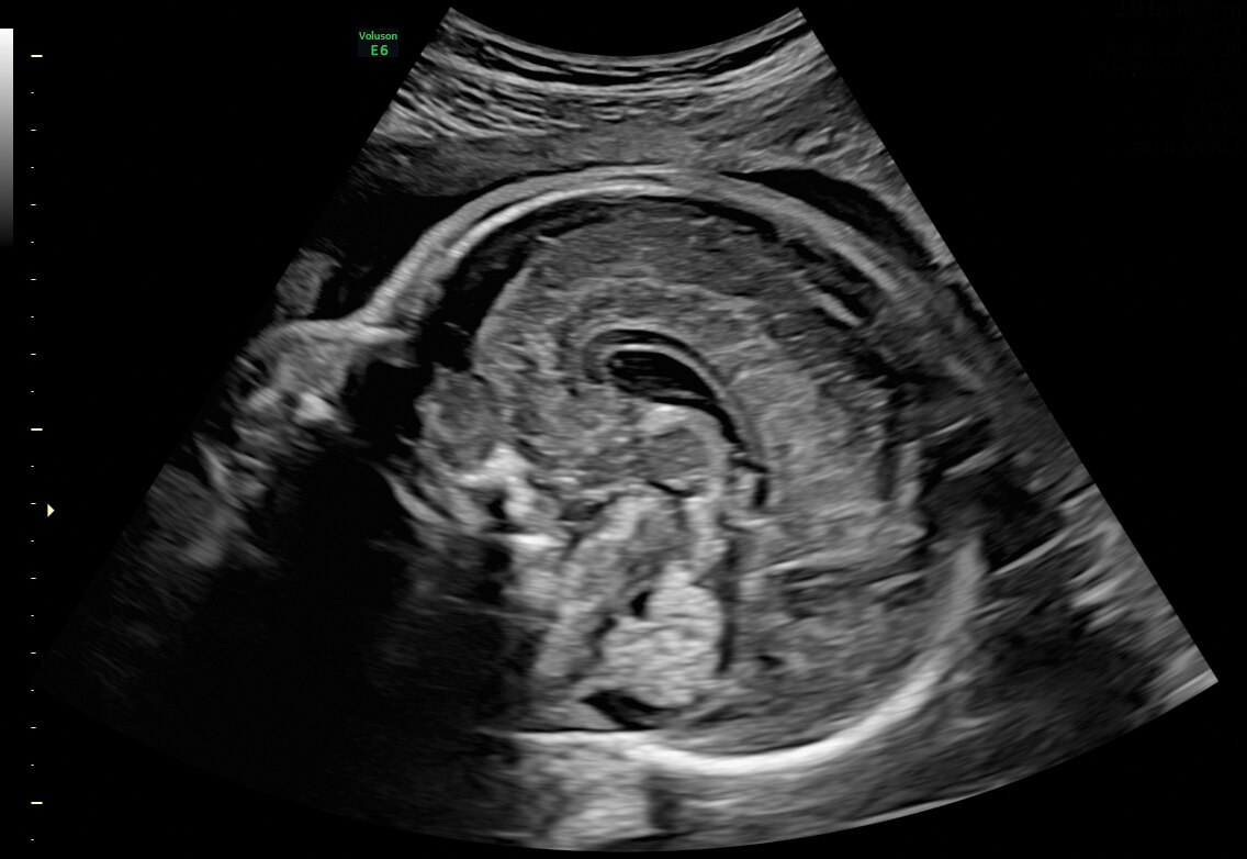 27 week corpus callosum and cerebellar vermis