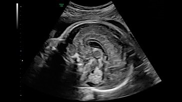 27 week corpus callosum and cerebellar vermis