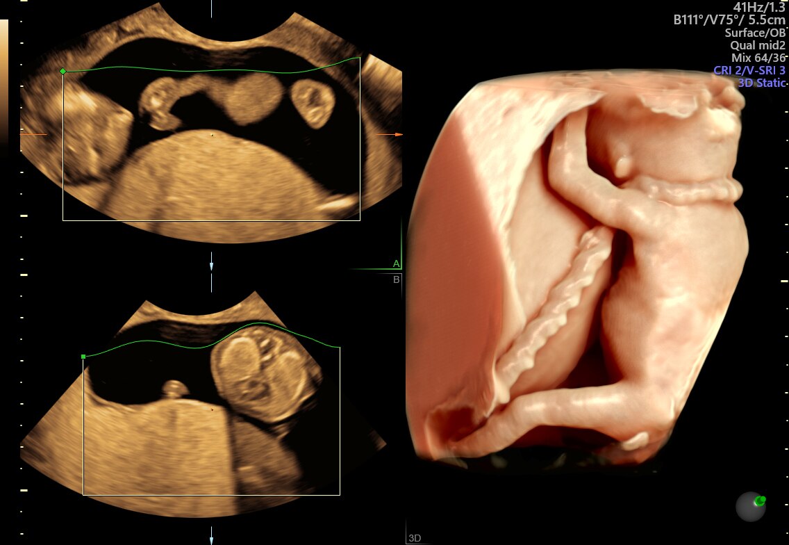 Fetus with HDlive™ generated with SonoRenderlive