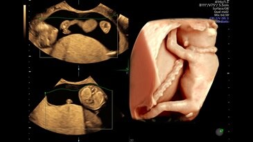 Fetus with HDlive™ generated with SonoRenderlive