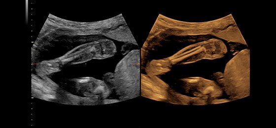Lower leg with VCI-A