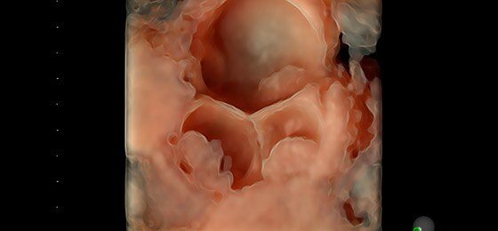 Complex adnexal mass with HDlive Silhouette
