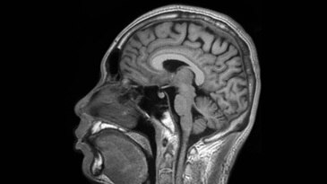 Brain: Silent T1 Sagittal Reformat