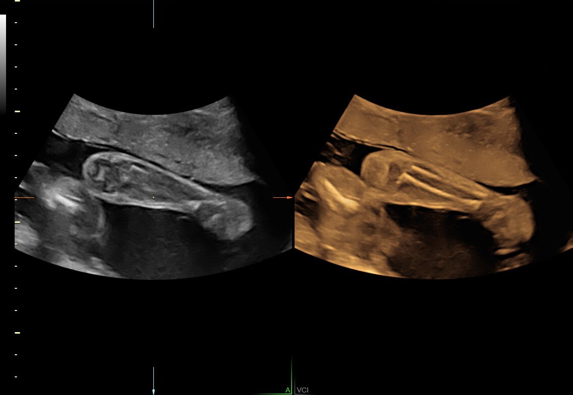 Volume Contrast Imaging-A (VCI-A) of the fetal arm