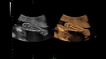 Volume Contrast Imaging-A (VCI-A) of the fetal arm