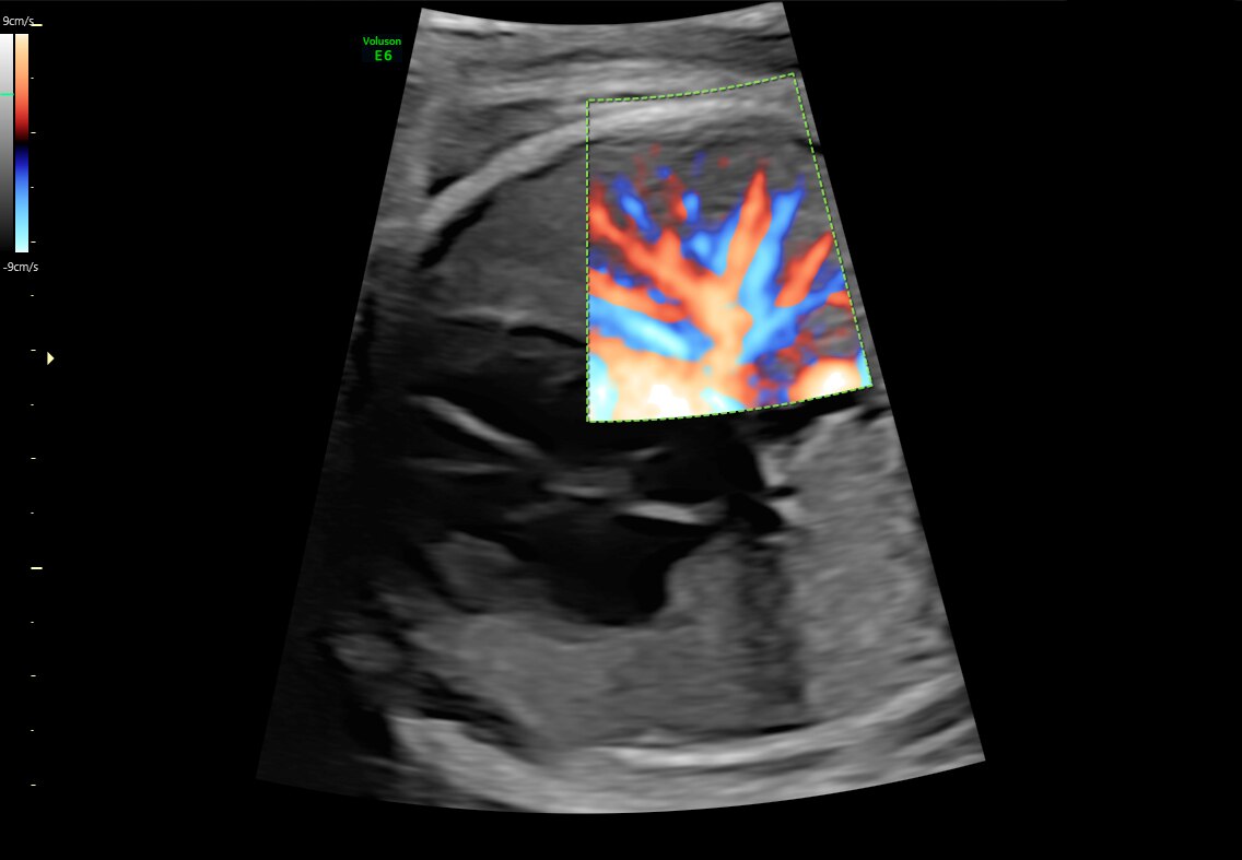 HD-Flow of 28 week heart and lung perfusion