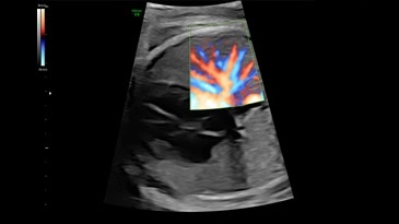 HD-Flow of 28 week heart and lung perfusion