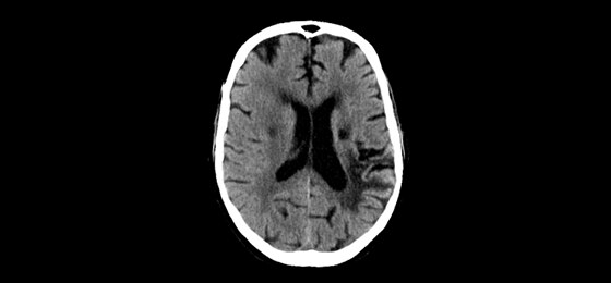 Deep Learning Image Reconstruction | 2.5 mm