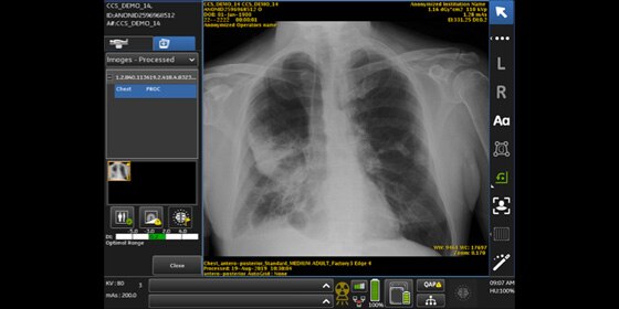 GE Healthcare AI-embedded X-Ray system