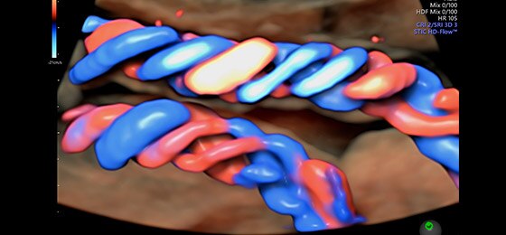 Umbilical cord with HDlive Flow