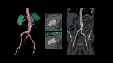 Low-dose and high-quality abdominal aortaEVAR stent assessment