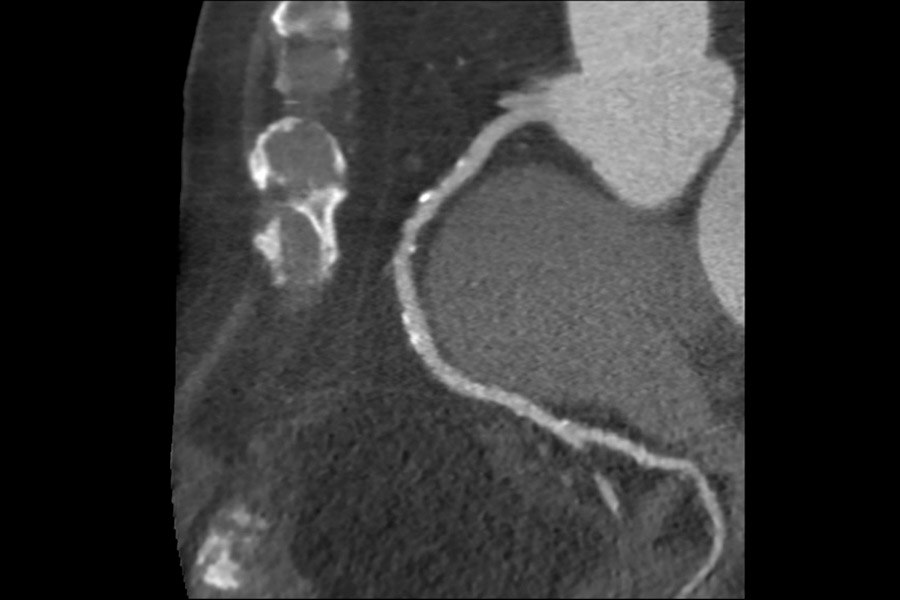 80-year-old male. Trigeminy. 45-186 BPM, BMI 28
