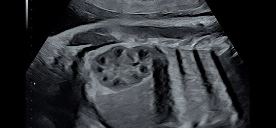 36 week fetal kidney