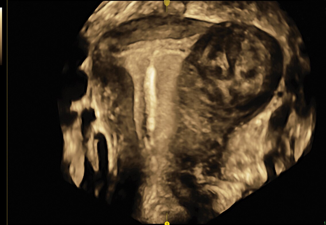 IUD and fibroid with OmniView