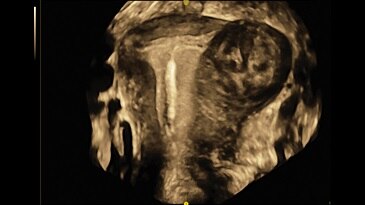 IUD and fibroid with OmniView