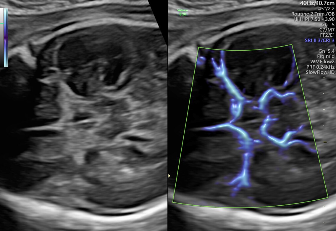 Circle of Willis shown with SlowflowHD in Dual Display