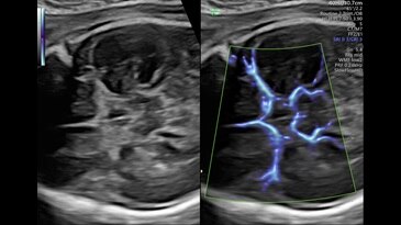 Circle of Willis shown with SlowflowHD in Dual Display