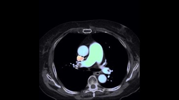 Pre-treatment: Thrombosis Image (Effective-Z)