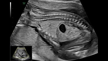 16 week lung and bowel