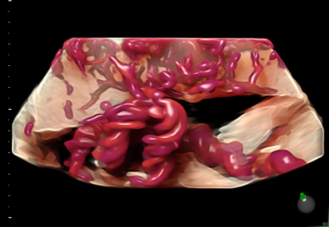 Umbilical cord placental insertion captured with HDlive Flow