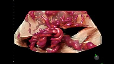 Umbilical cord placental insertion captured with HDlive Flow