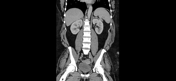 Deep Learning Image Reconstruction | 0.625 mm