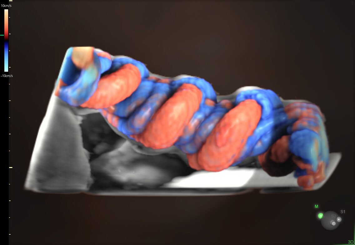 HDlive Flow with umbilical cord