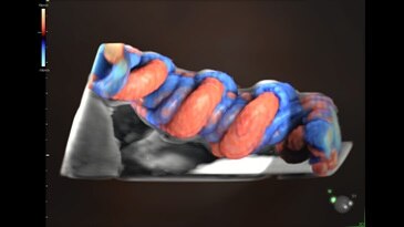 HDlive Flow with umbilical cord