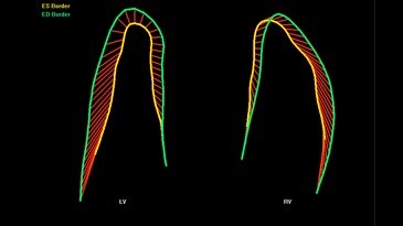 Fetal heart contractility demonstrated with fetalHQ