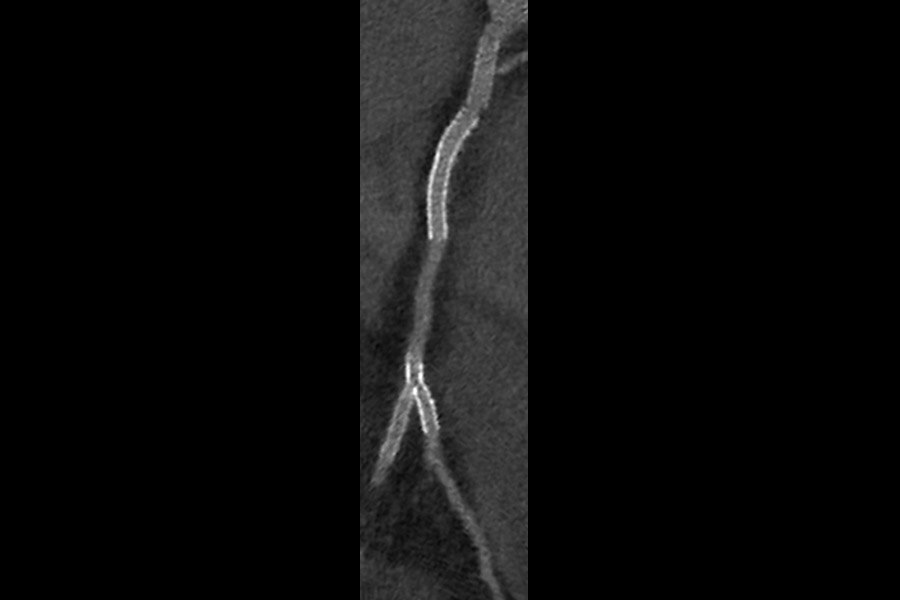 Visualization of the lumen of stents on 53-year-old male, 51 BPM, BMI 31