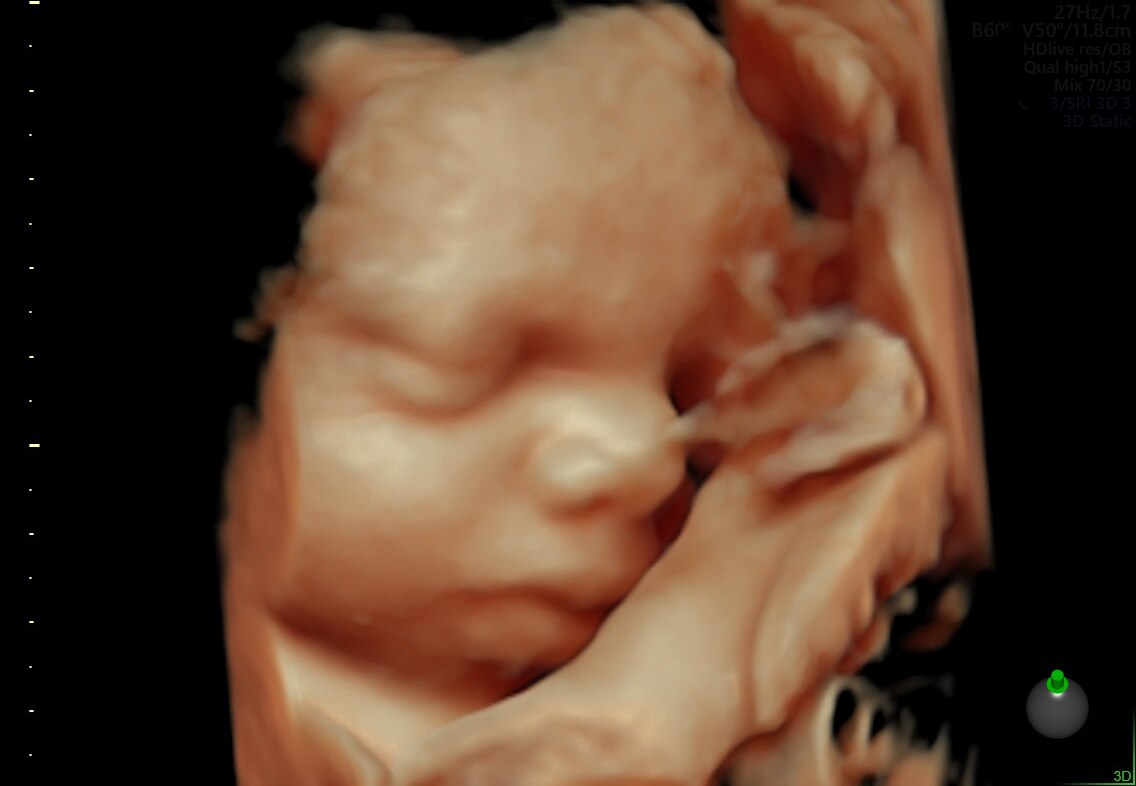 Fetal face and cord rendered with HDlive™