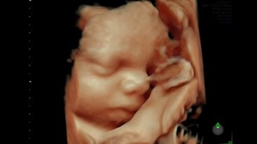 Fetal face and cord rendered with HDlive™