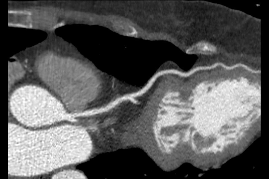 Submilisievert CCTA. 57 kg, 56-year-old female, 60 BPM, 0.5 mSv