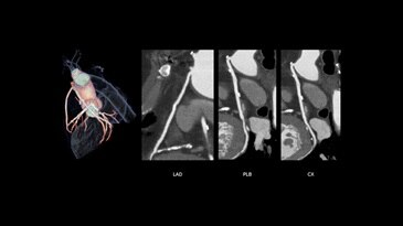 CCTA - Bypass Graft Follow-up
