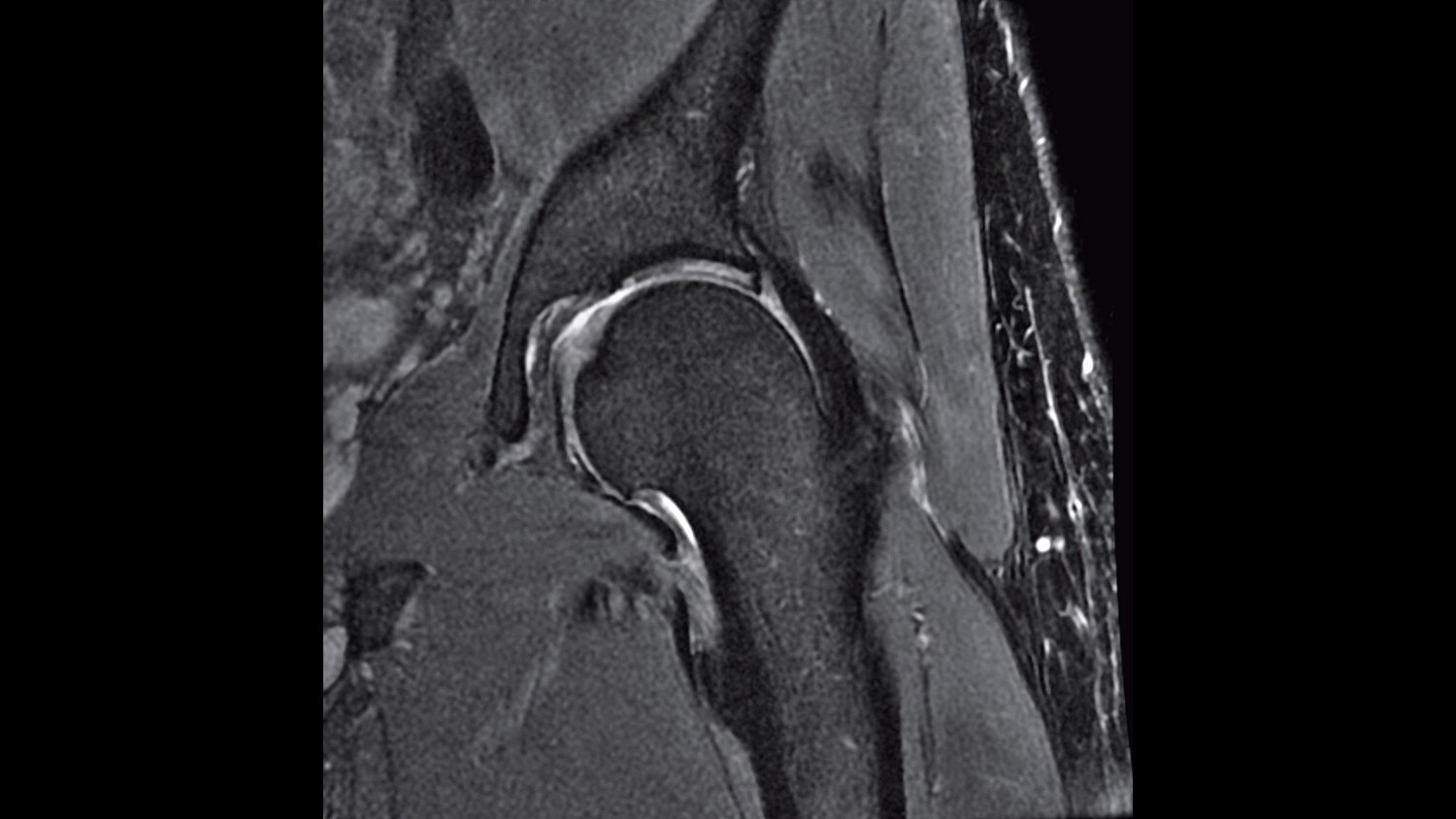 PD FSE Fat Sat Coronal