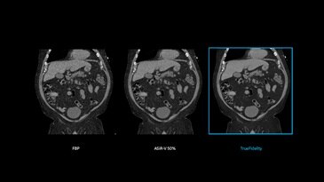 Abdomen imaging: reconstruction technologies comparison