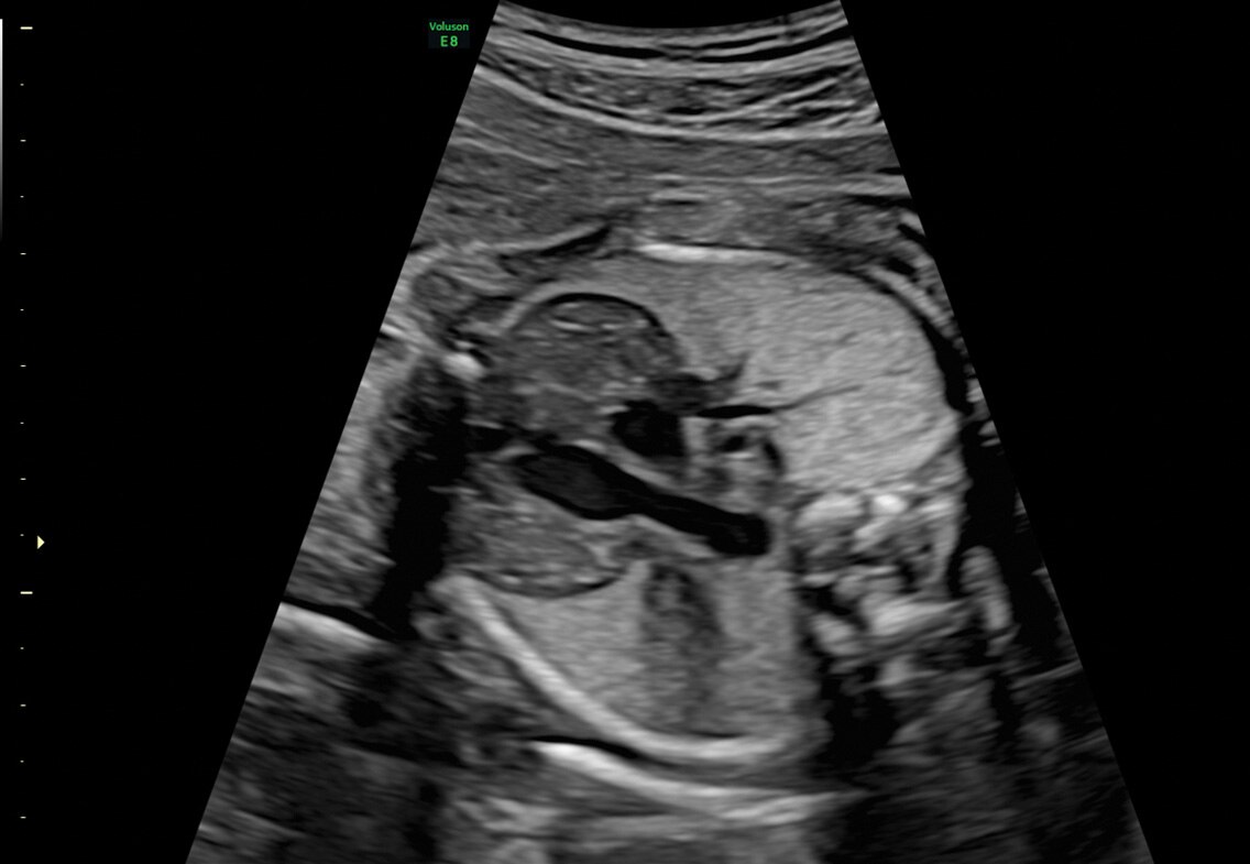 26 week fetal thymus gland