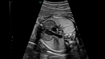 26 week fetal thymus gland