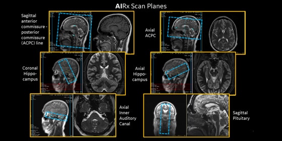 GE Healthcare’s AI-based, automated workflow tool for MRI