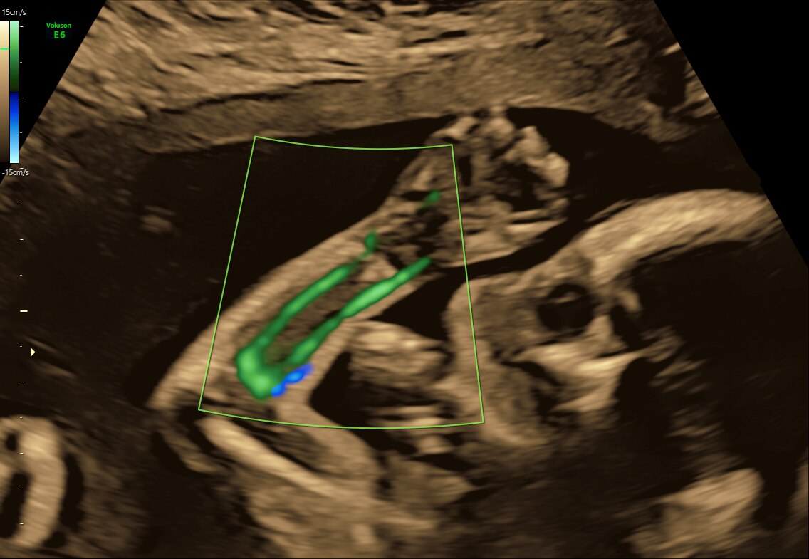 HD-Flow™ in fetal arm using C1-6-D probe