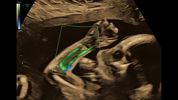 HD-Flow™ in fetal arm using C1-6-D probe