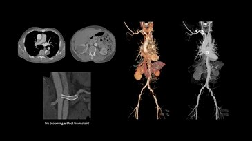 Low-dose exam showing a total aorta dissection