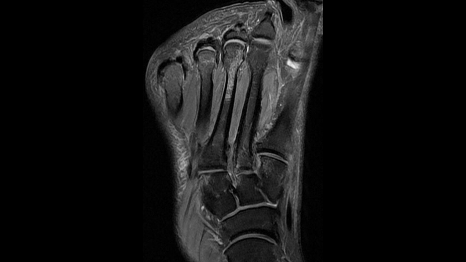 PD frFSE Fat Sat Coronal