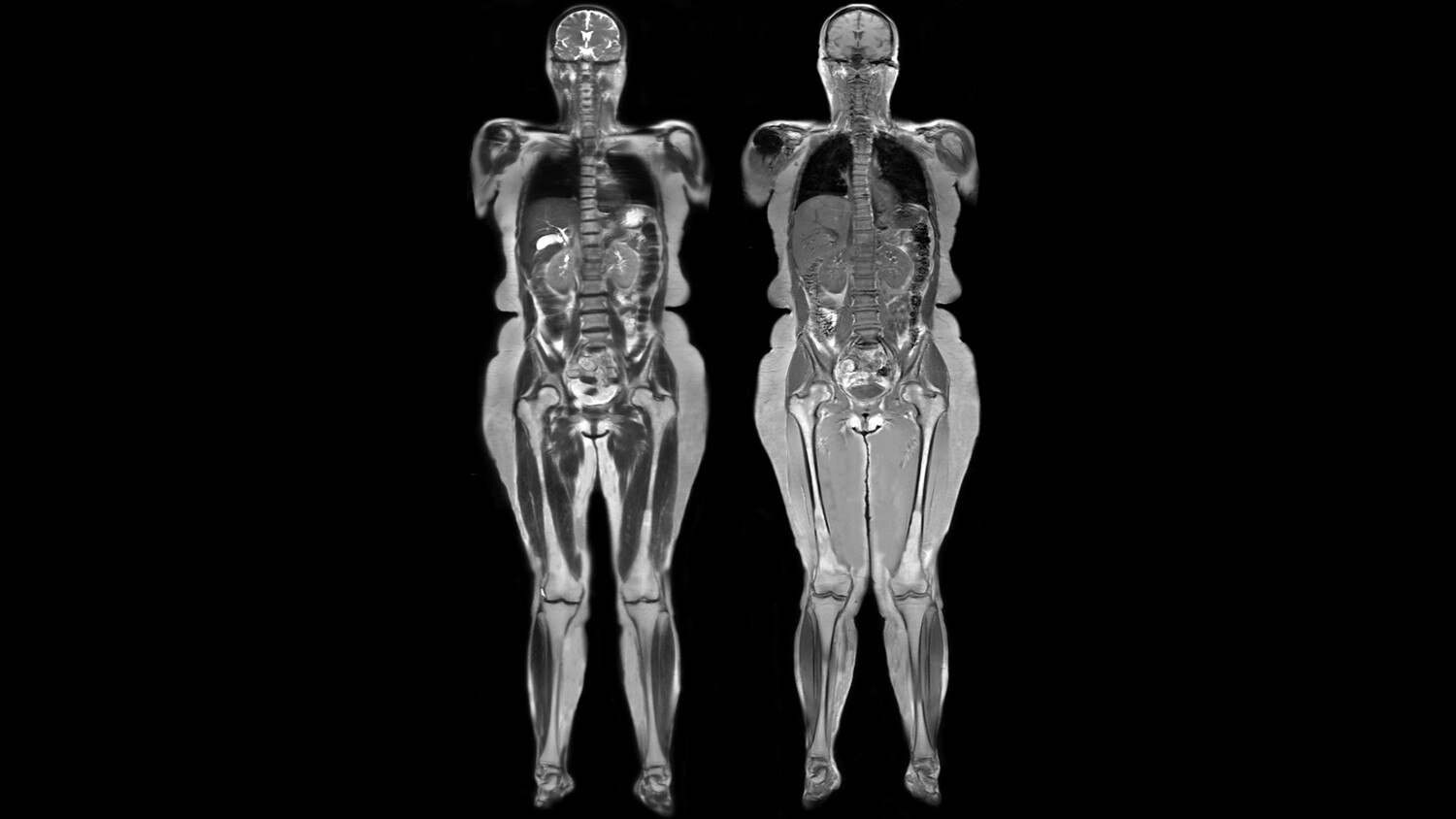 Whole Body imaging with GEM Suite using T1 fsPGR and T2 SSFSE with ARC acceleration.