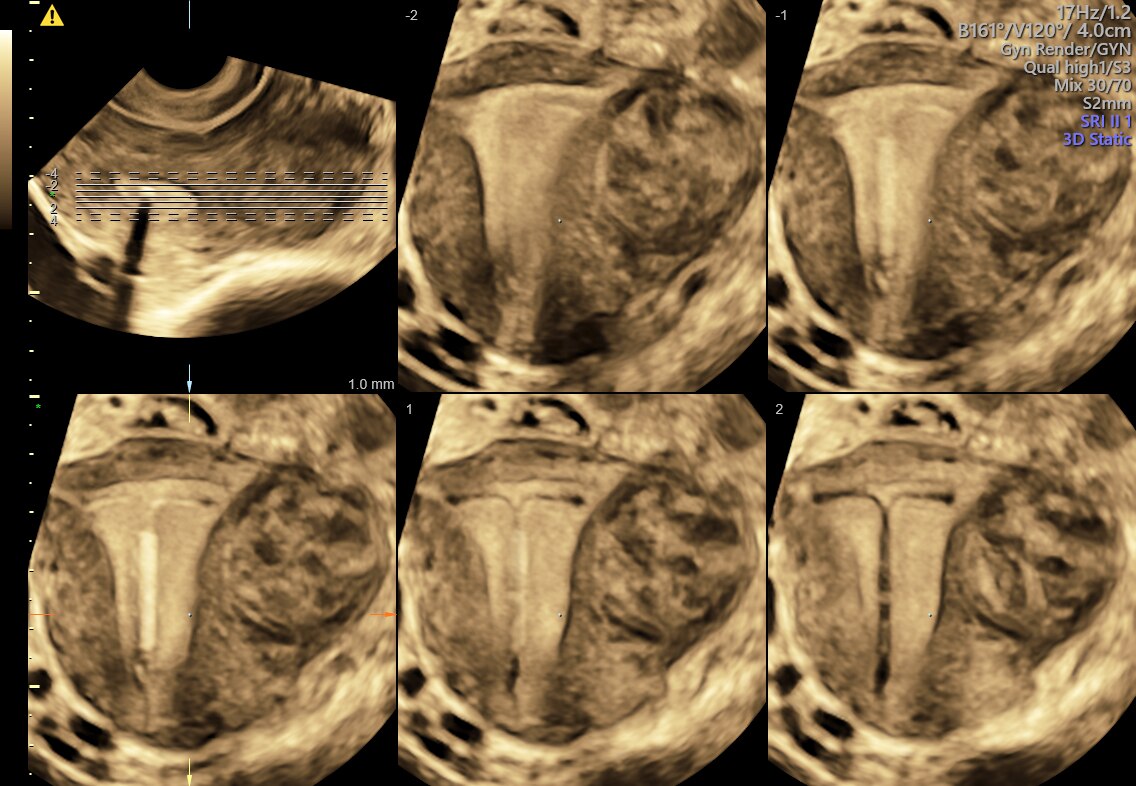 Coronal uterus with IUD and fibroid displayed with OmniView