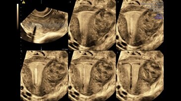 Coronal uterus with IUD and fibroid displayed with OmniView