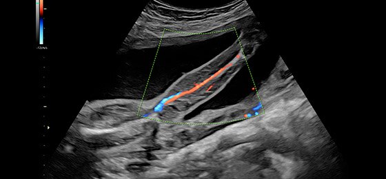 Vascularization of leg with HD-Flow™