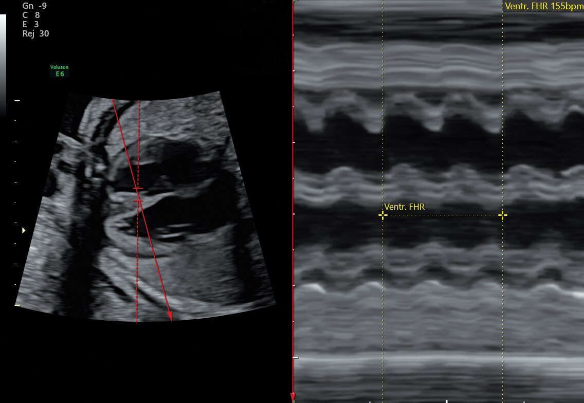 Anatomic M-Mode through 27 week fetal heart