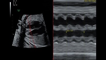 Anatomic M-Mode through 27 week fetal heart
